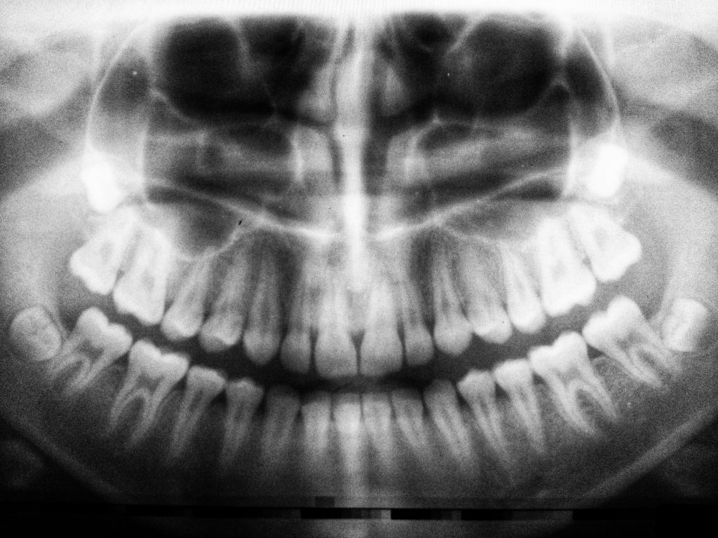 premolar with 3 roots