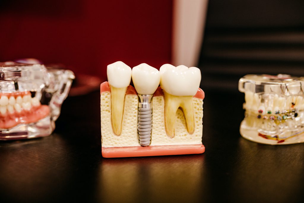when is a dental implant needed