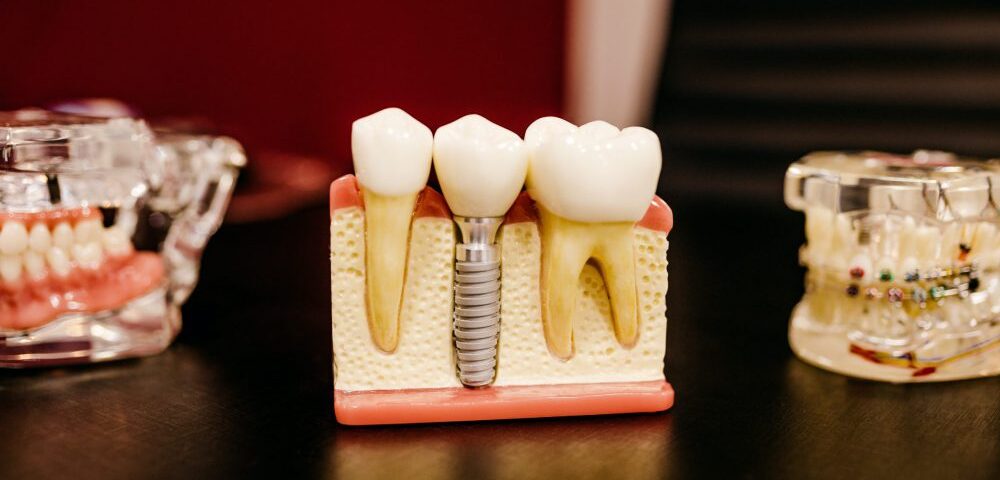 when is a dental implant needed