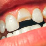 what can be done when a tooth breaks