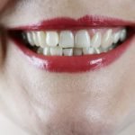 what is root resorption
