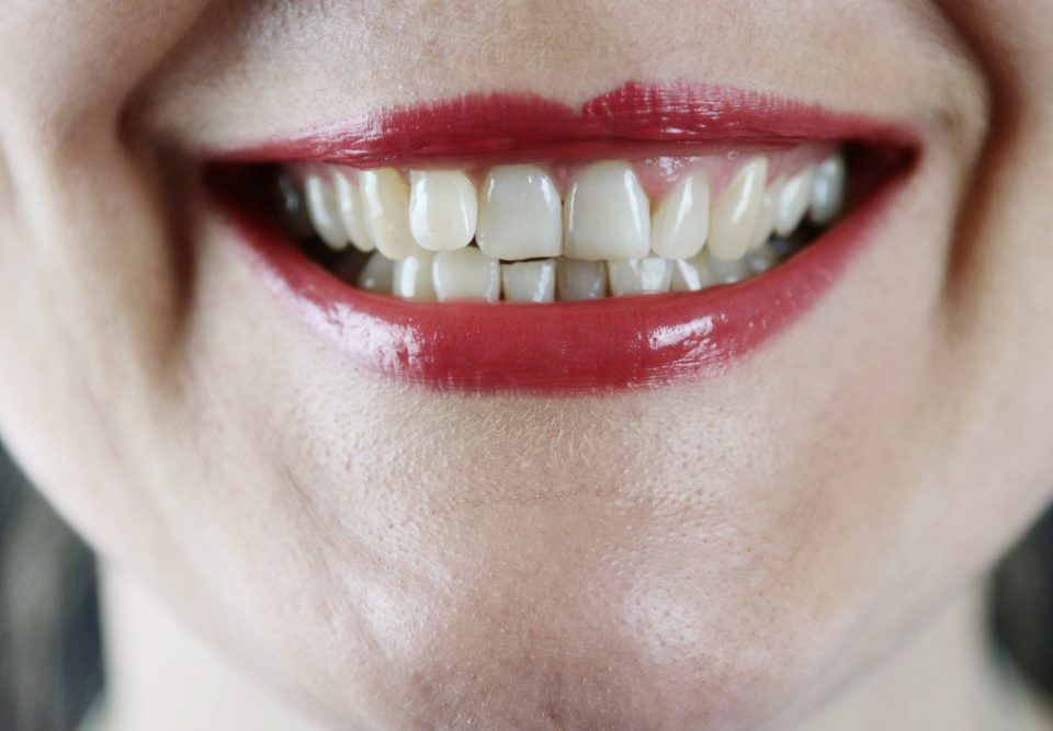 what is root resorption